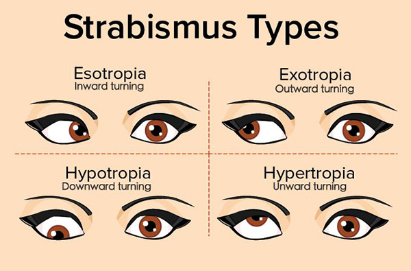 Strabismus